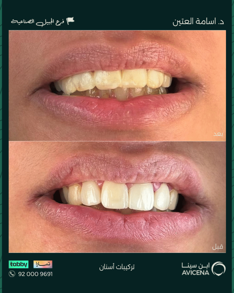 د. أسامة العتين - قبل وبعد