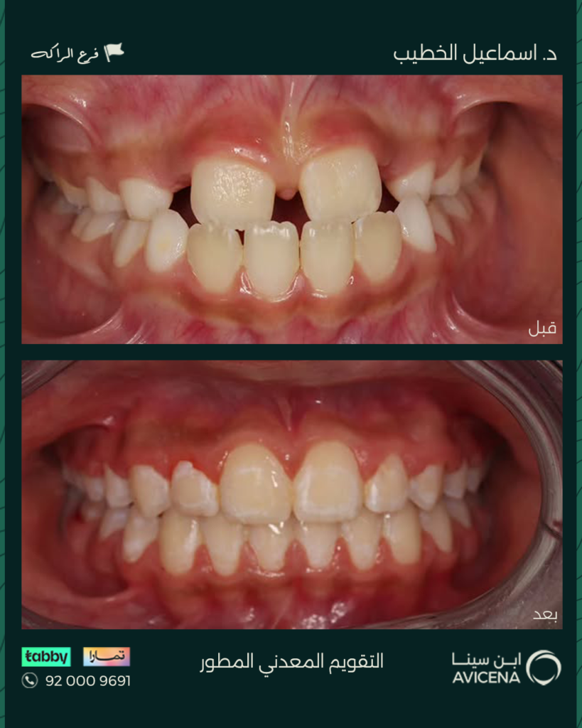 د. إسماعيل الخطيب - قبل وبعد