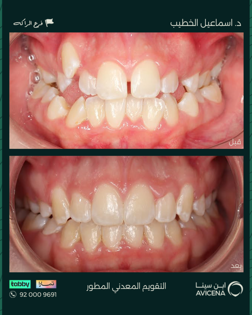 د. إسماعيل الخطيب - قبل وبعد