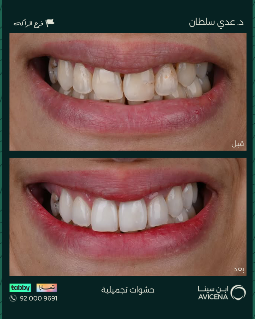 د. عدى السلطان - قبل وبعد