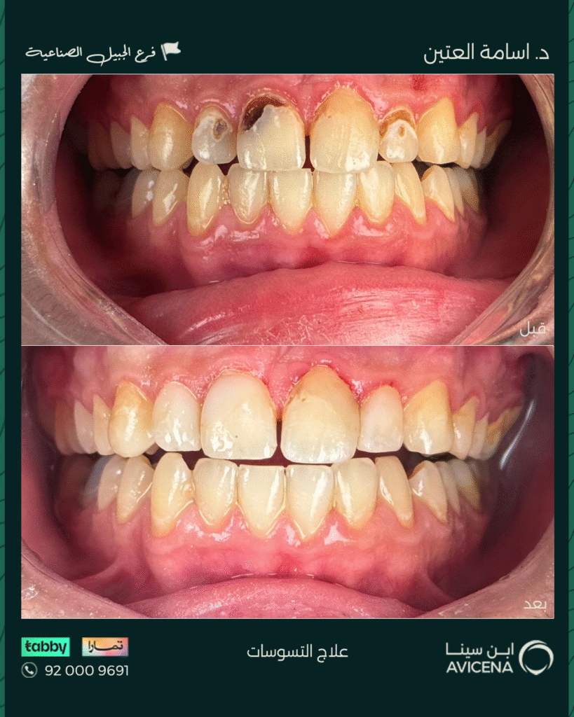 د. أسامة العتين - قبل وبعد