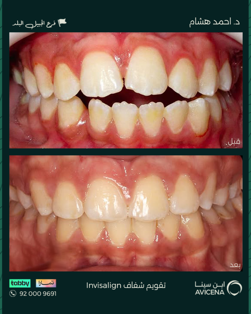 Dr Ahmed Hisham Abdulhadi - Before After