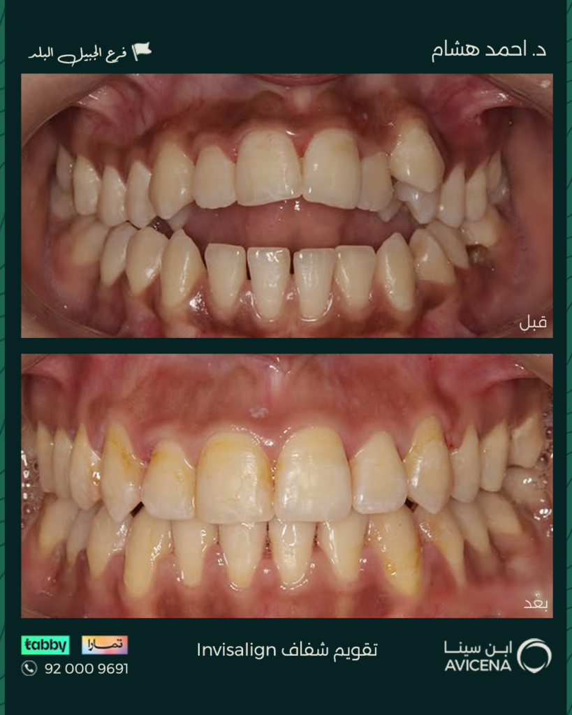 Dr Ahmed Hisham Abdulhadi - Before After