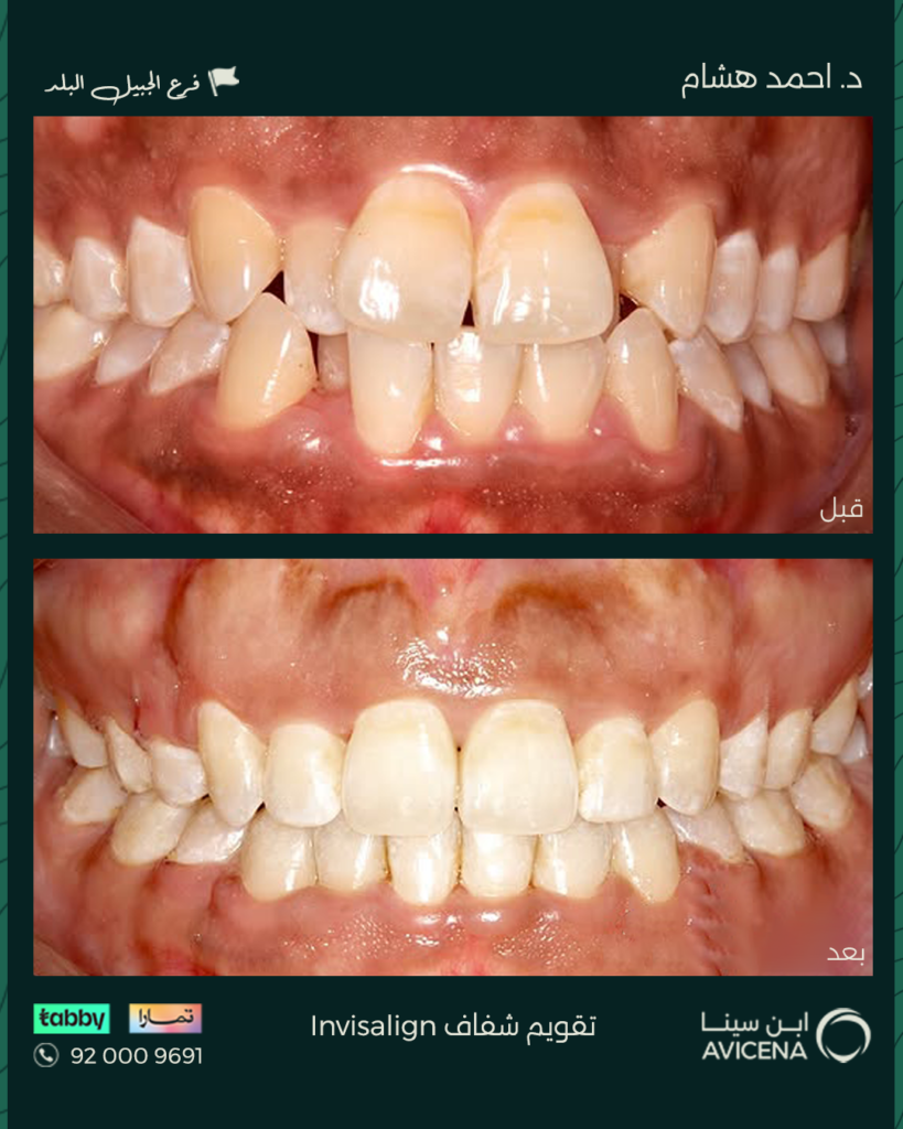 Dr Ahmed Hisham Abdulhadi - Before After