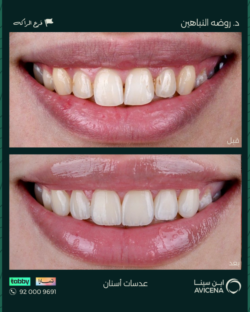 د. روضة النباهين - قبل وبعد
