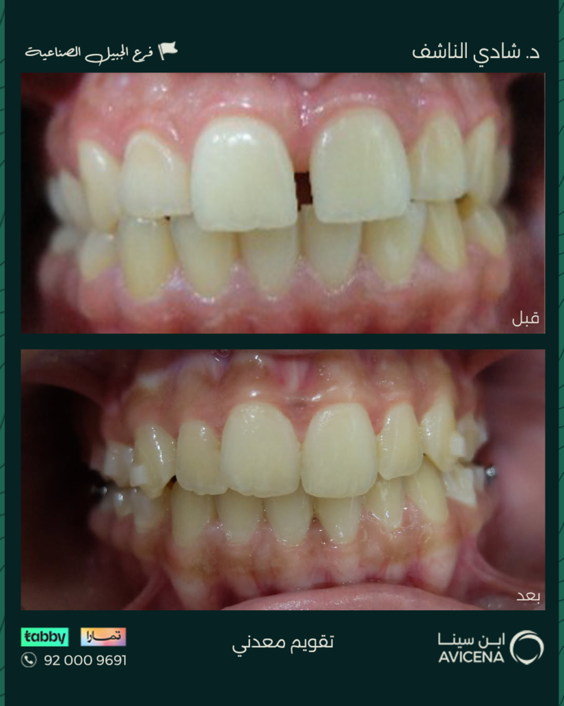 د. شادي الناشف - قبل وبعد