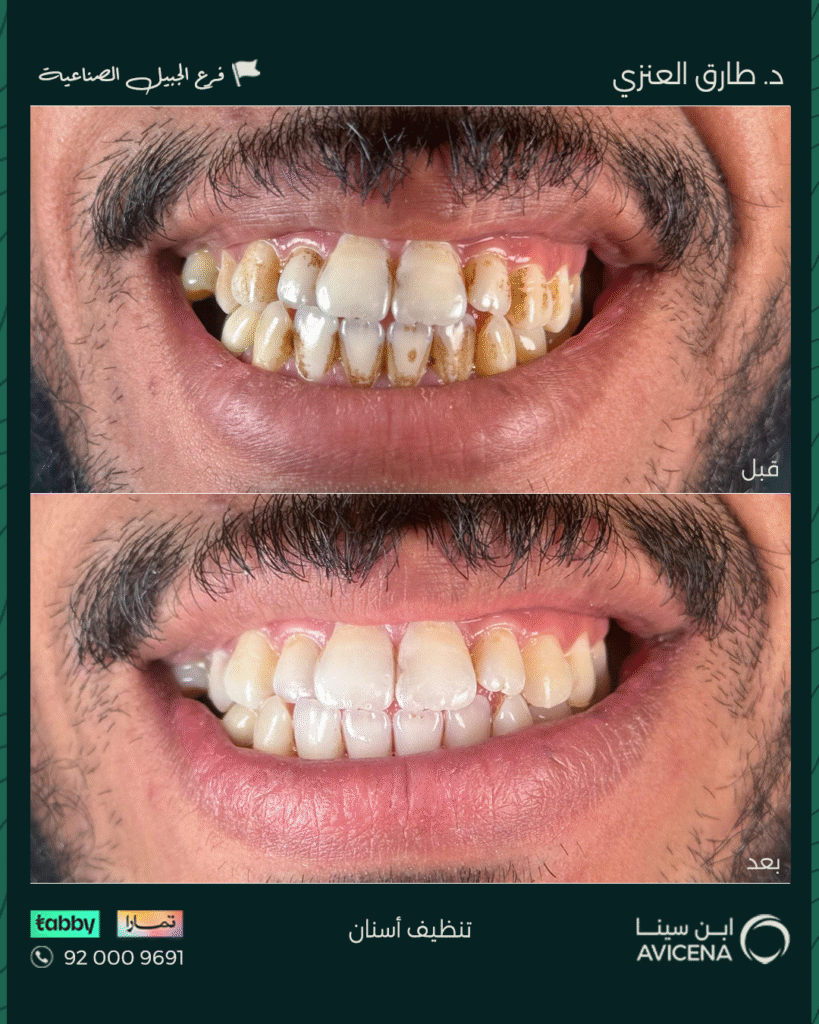 د. طارق العنزي - قبل وبعد