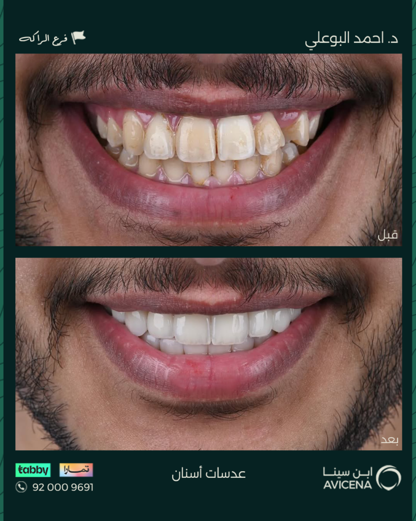 د. أحمد البوعلي - قبل وبعد