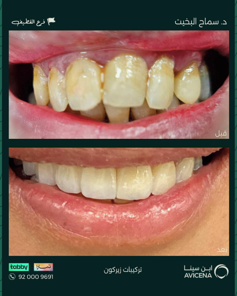 د. سماح البخيت - قبل وبعد