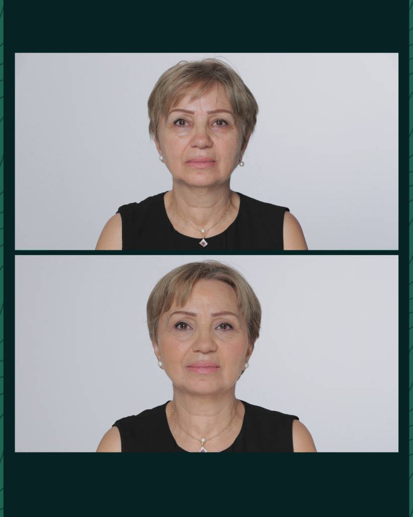 جهاز الهايفو - Before After