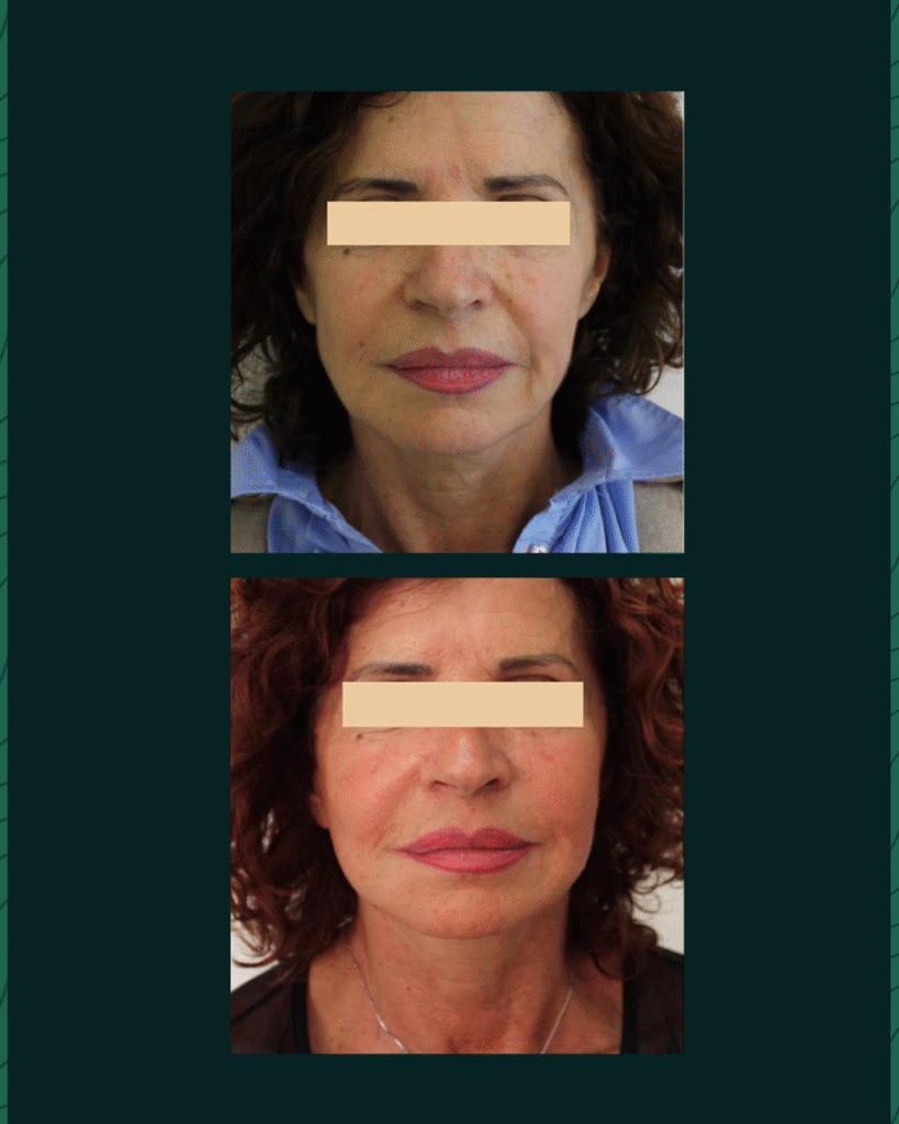 جهاز الهايفو - Before After