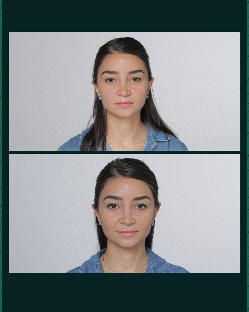 جهاز الهايفو - Before After