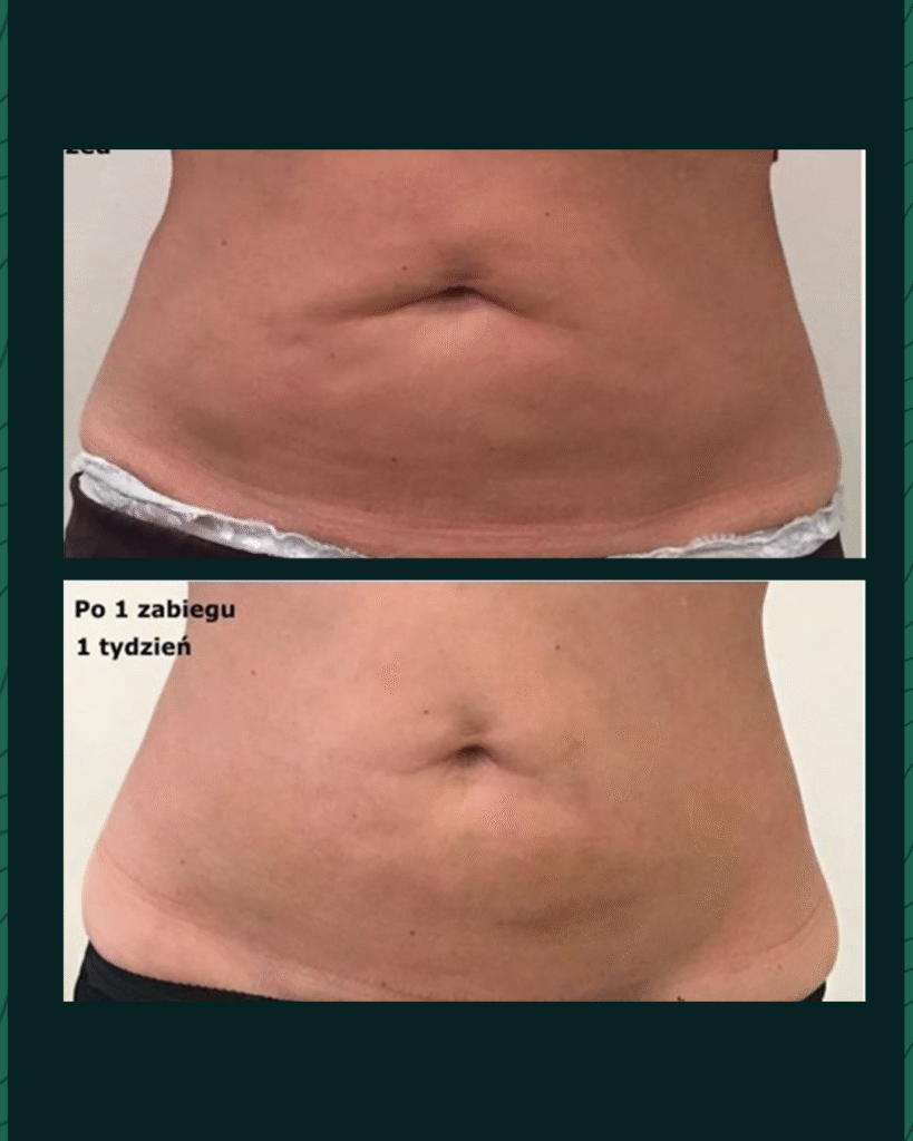 جهاز الهايفو - Before After