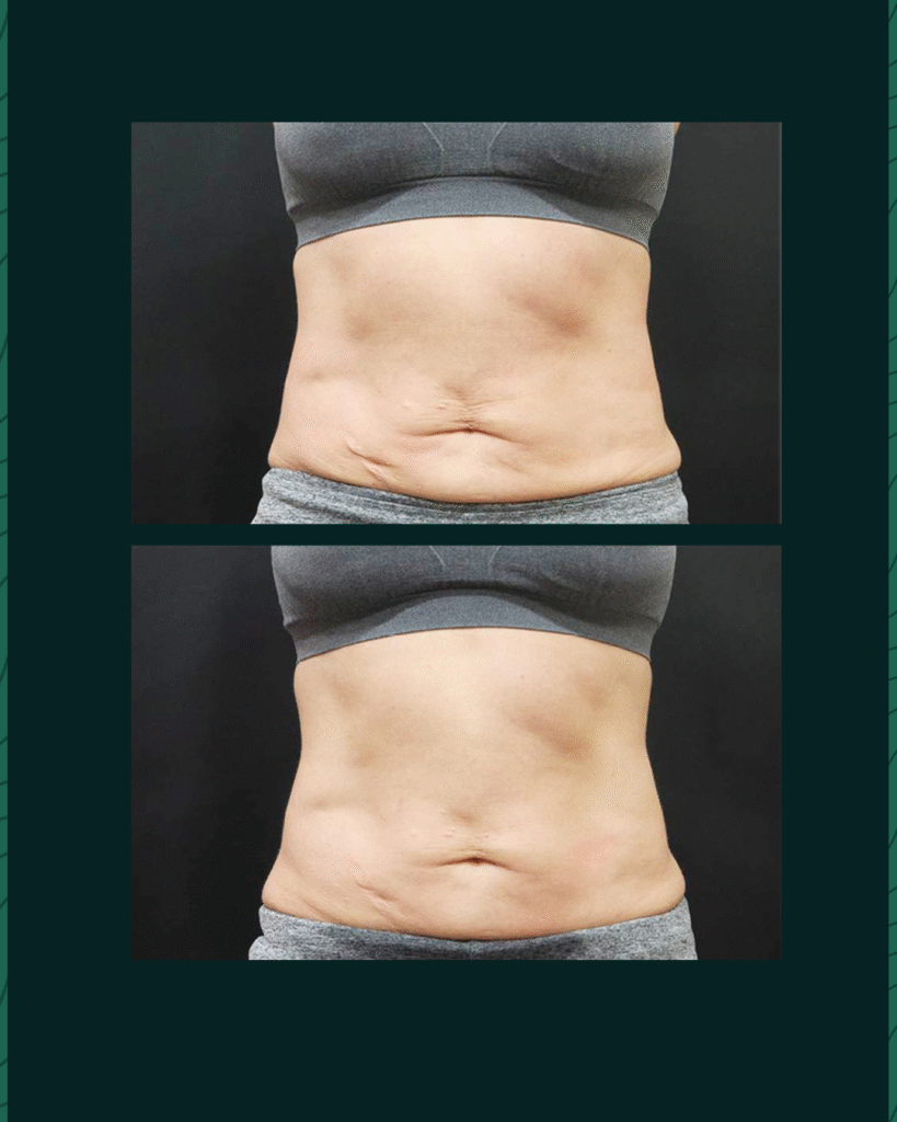 جهاز الهايفو - Before After