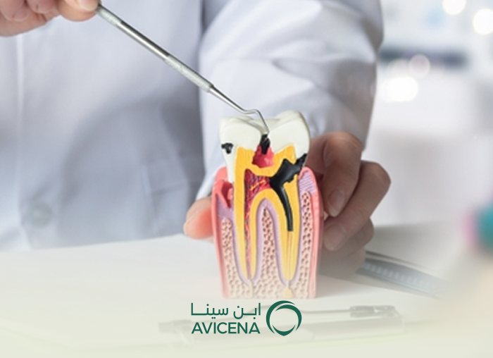 علاج جذور الأسنان