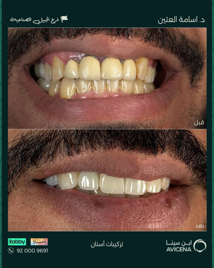 Dr. Osama Al-Atin - Before After