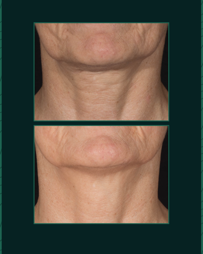 بوتنزا - Before After