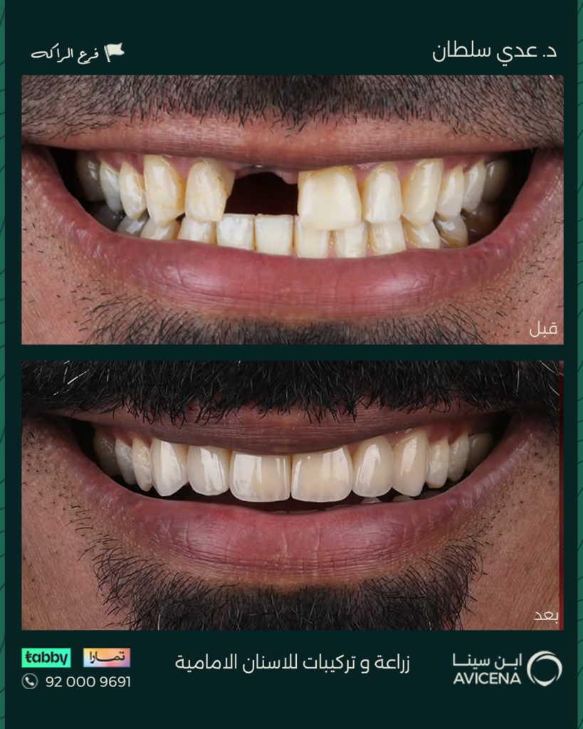 Dr. odi Al-Sultan - Before After