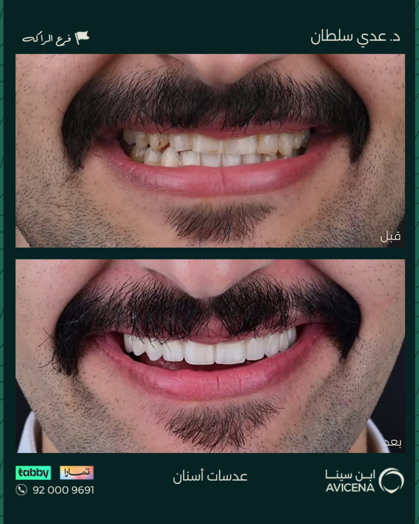 Dr. odi Al-Sultan - Before After