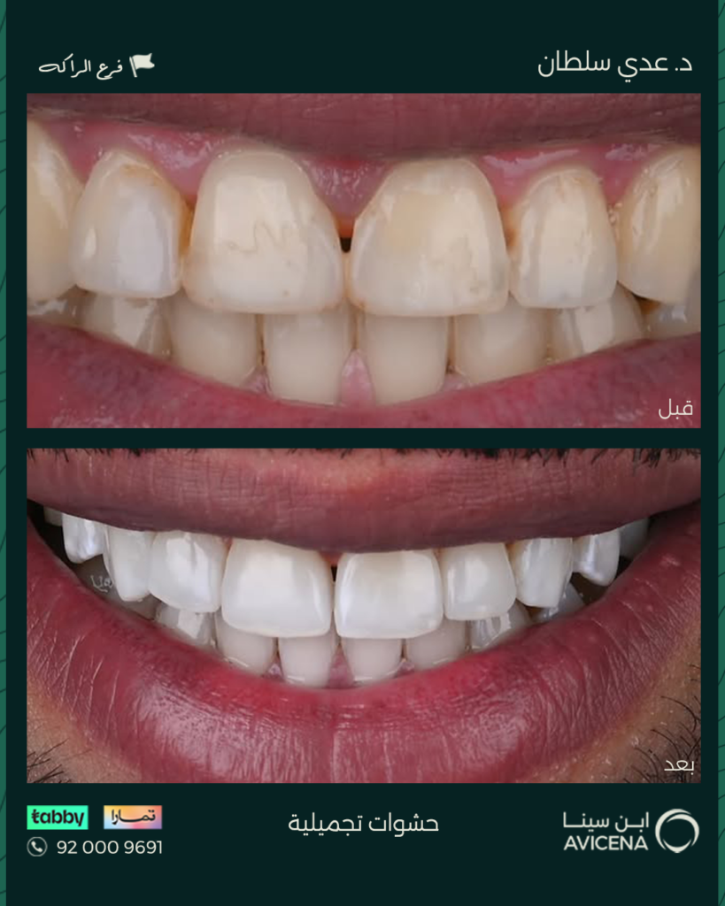 Dr. odi Al-Sultan - Before After