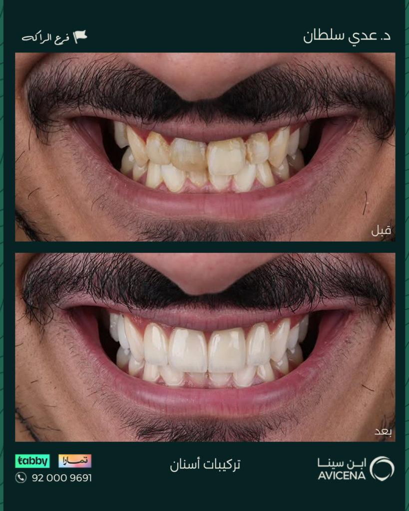 Dr. odi Al-Sultan - Before After