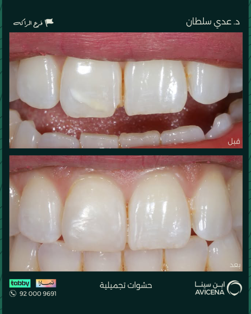 Dr. odi Al-Sultan - Before After