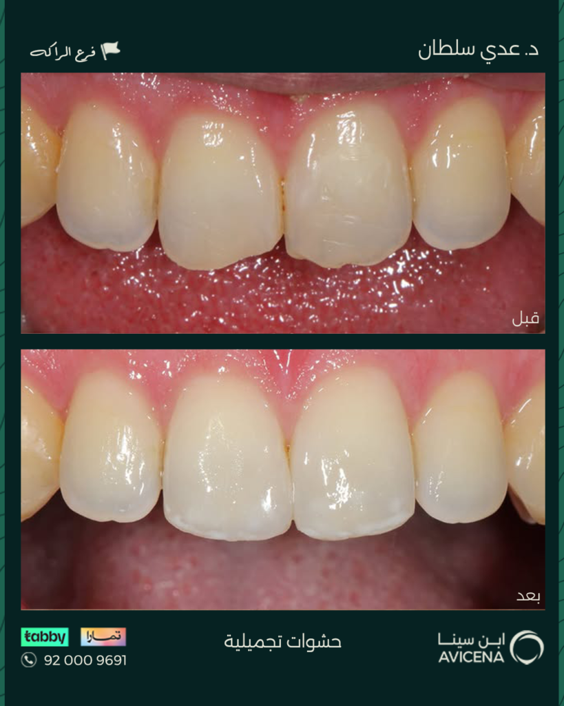 Dr. odi Al-Sultan - Before After
