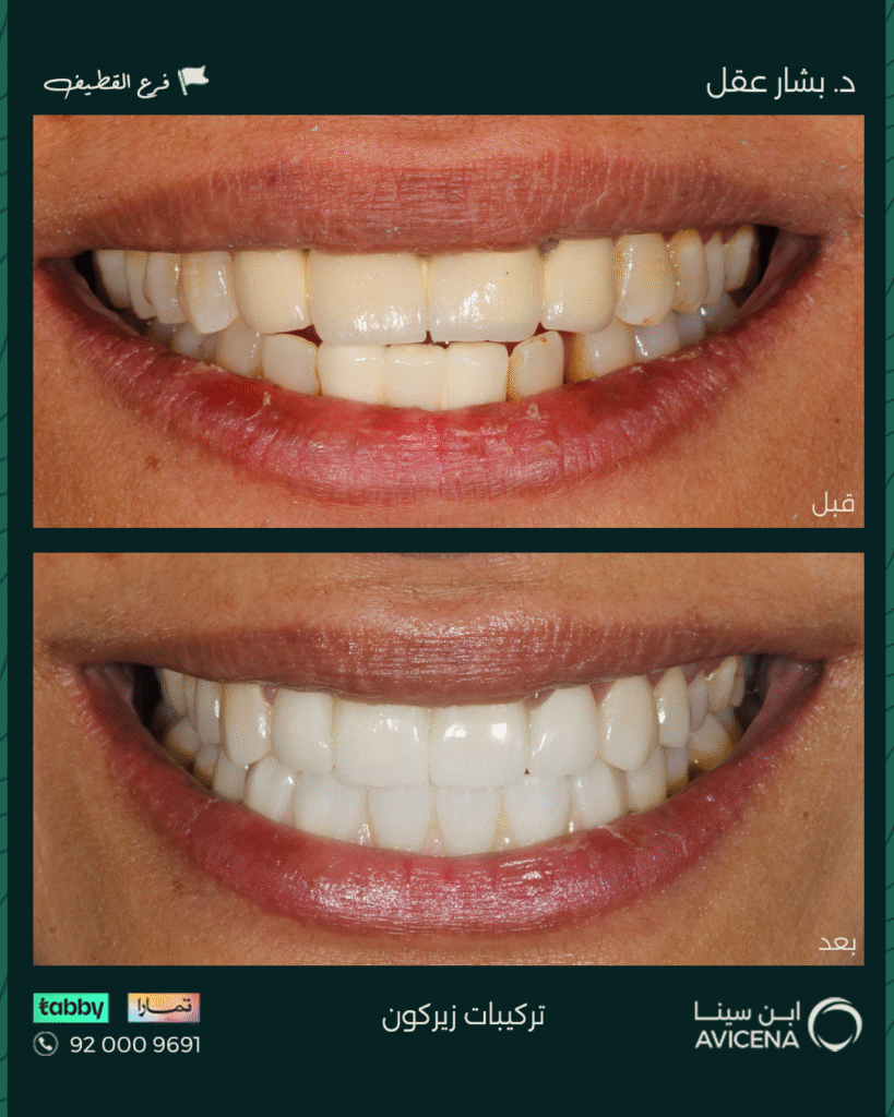 Dr. Bashar Aql - Before After