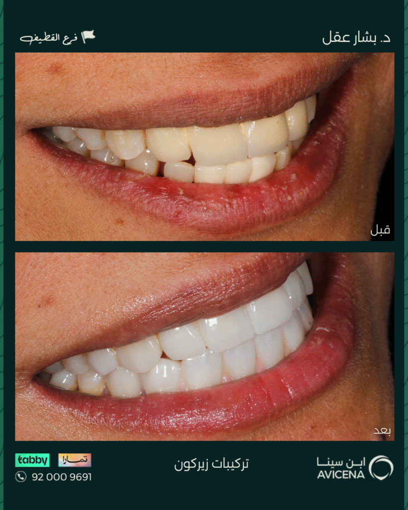 Dr. Bashar Aql - Before After