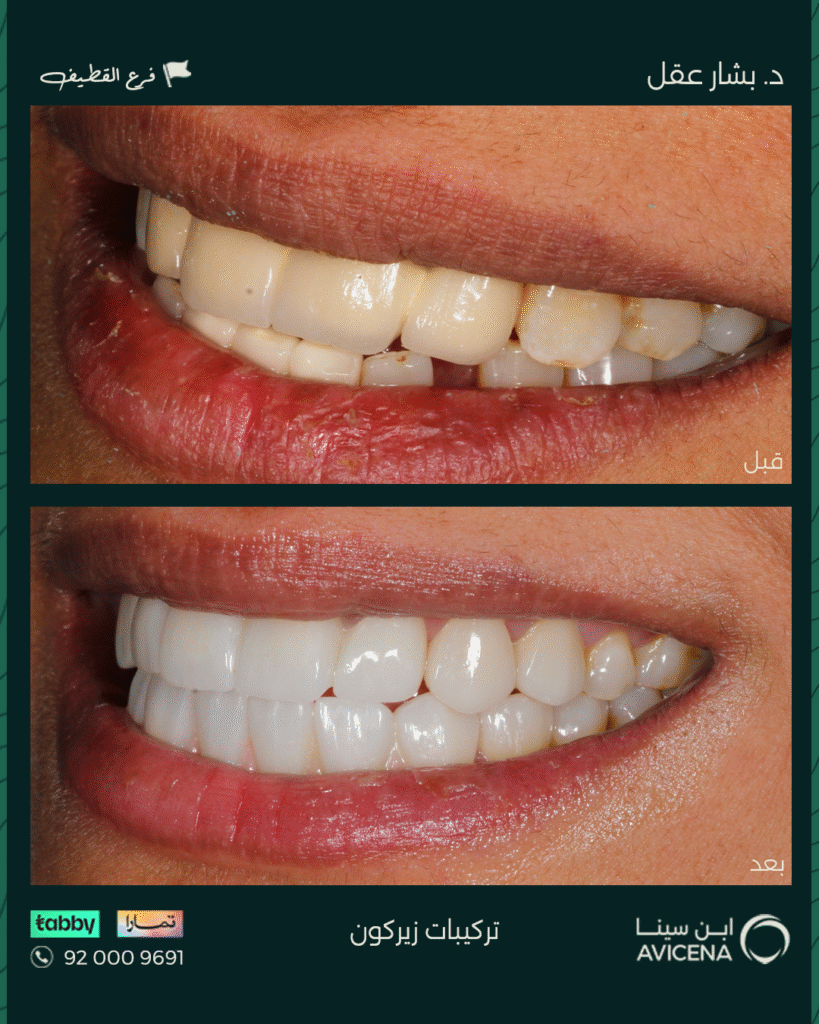 Dr. Bashar Aql - Before After