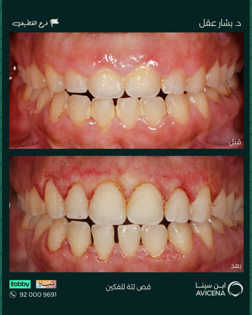 Dr. Bashar Aql - Before After