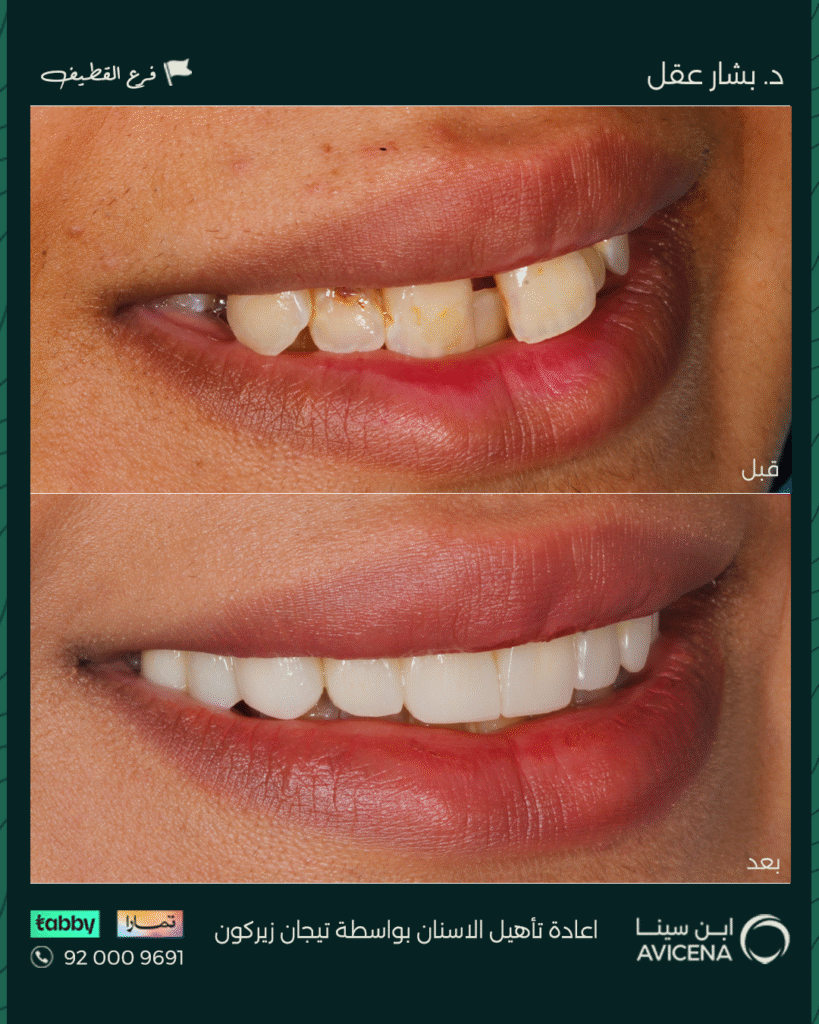 Dr. Bashar Aql - Before After