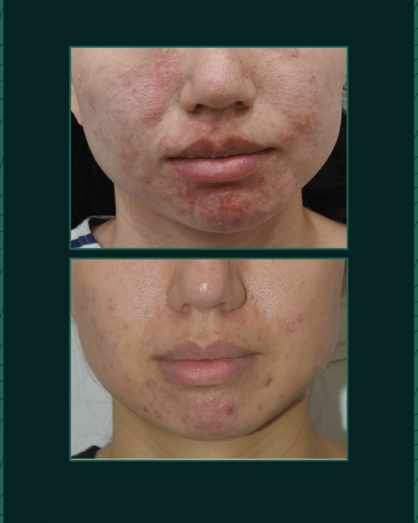 بوتنزا - Before After