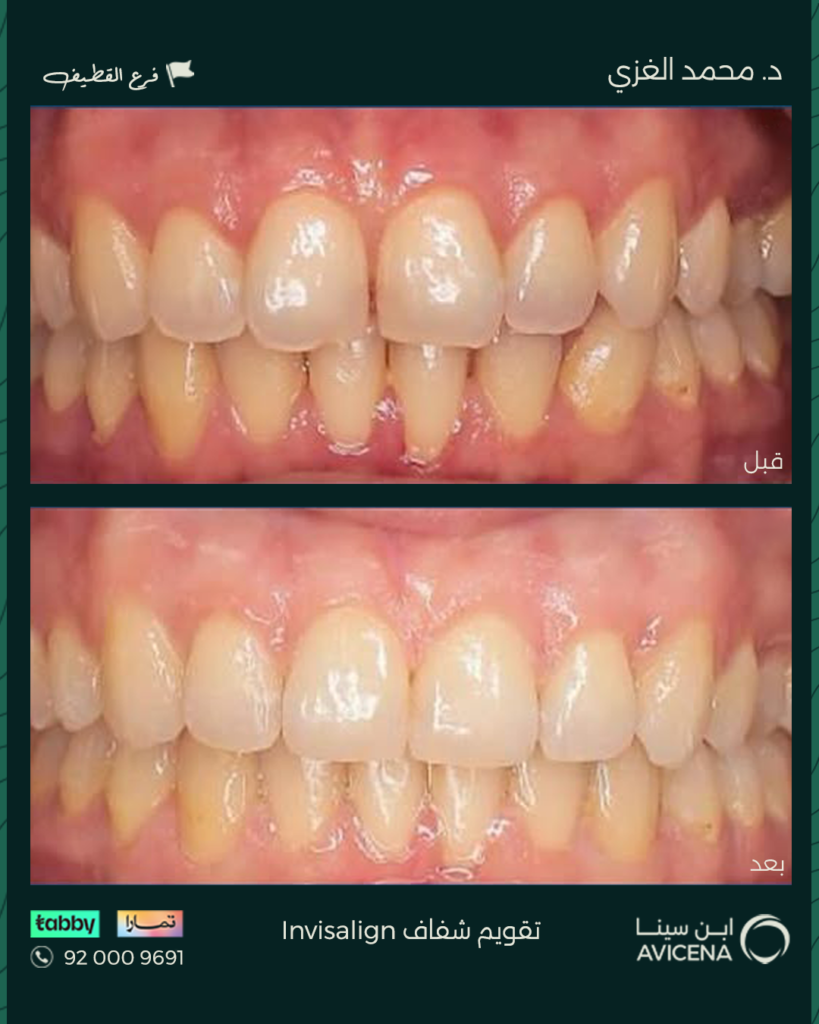 Dr. Mohammed Al-Ghazi - Before After