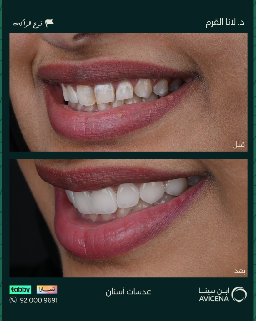 Dr. Lana Al-Qarm - Before After