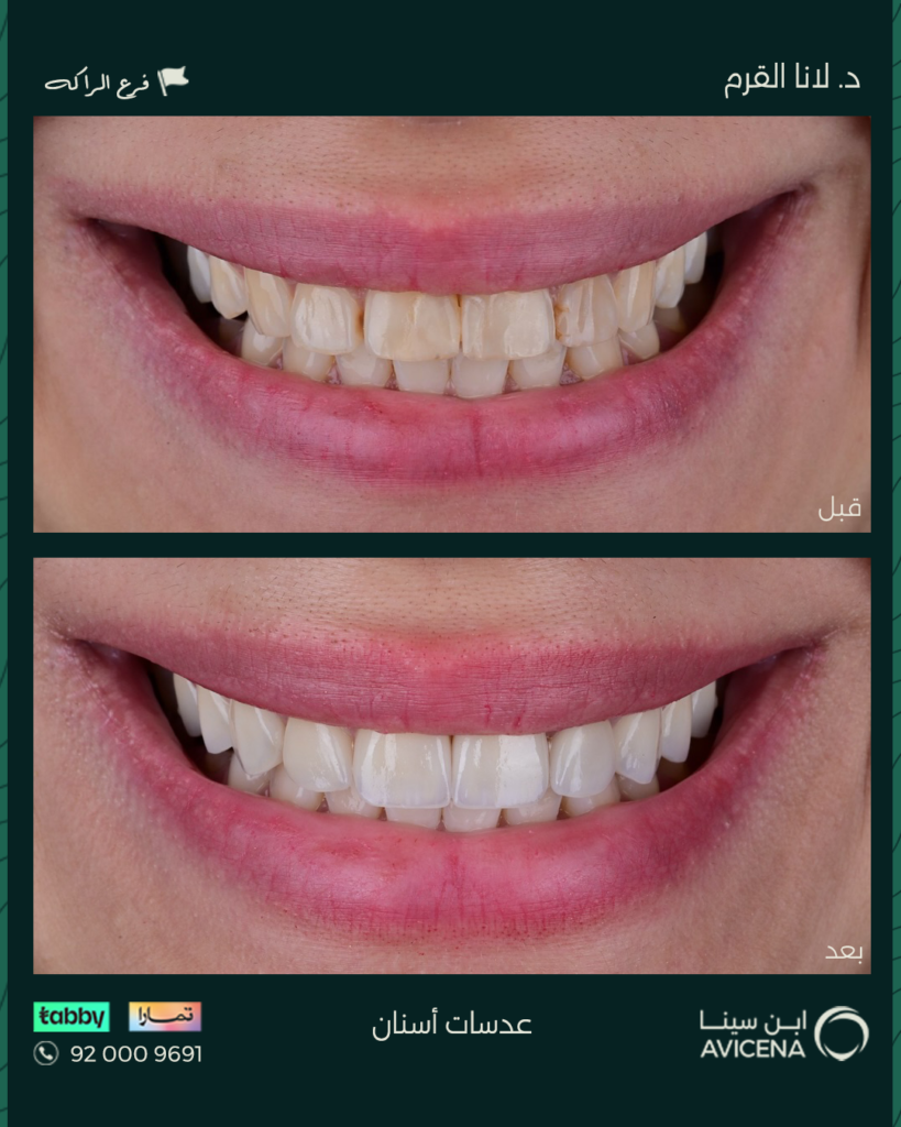 Dr. Lana Al-Qarm - Before After