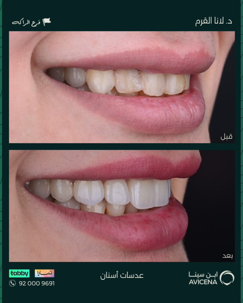 Dr. Lana Al-Qarm - Before After