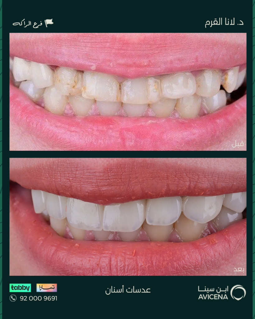 Dr. Lana Al-Qarm - Before After