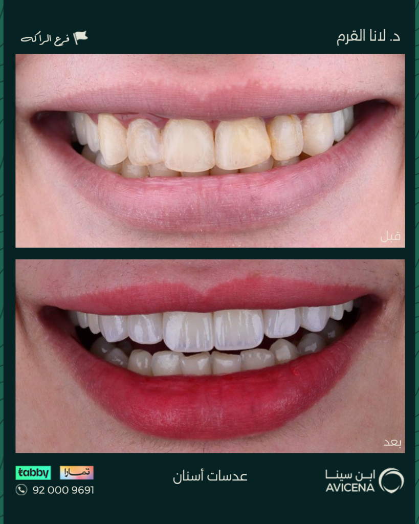 Dr. Lana Al-Qarm - Before After