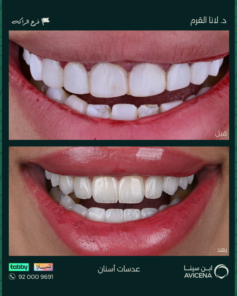 Dr. Lana Al-Qarm - Before After