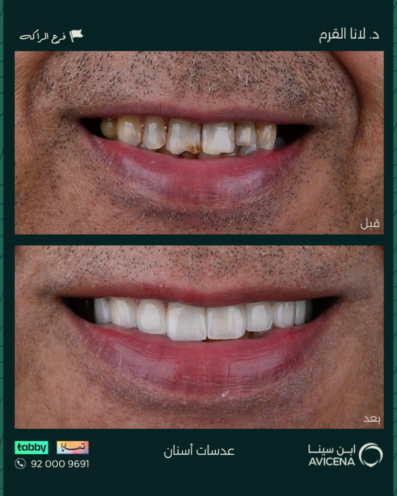 Dr. Lana Al-Qarm - Before After