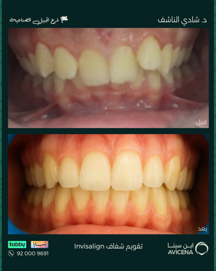 Dr. Shadi Al-Nashef - Before After
