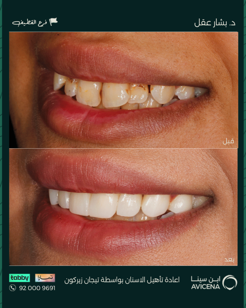 Dr. Bashar Aql - Before After