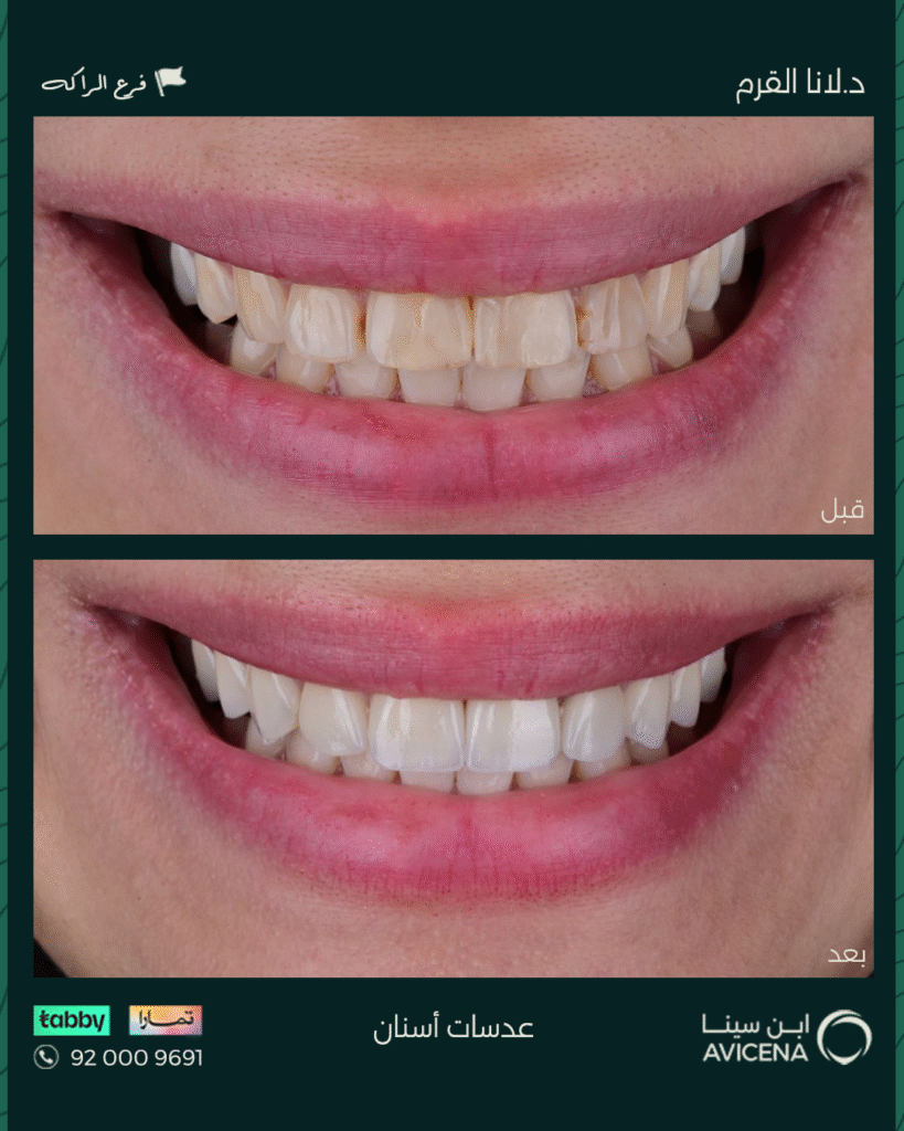 Dr. Lana Al-Qarm - Before After