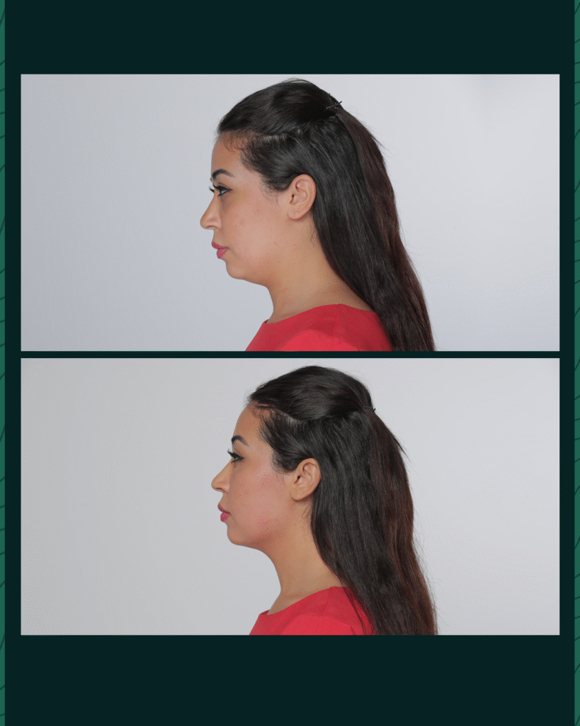 HIFU Device - Before After