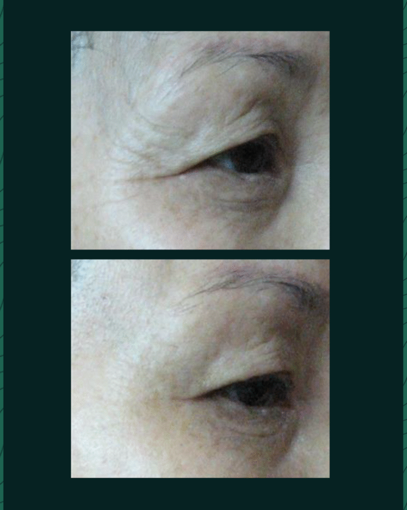 HIFU Device - Before After