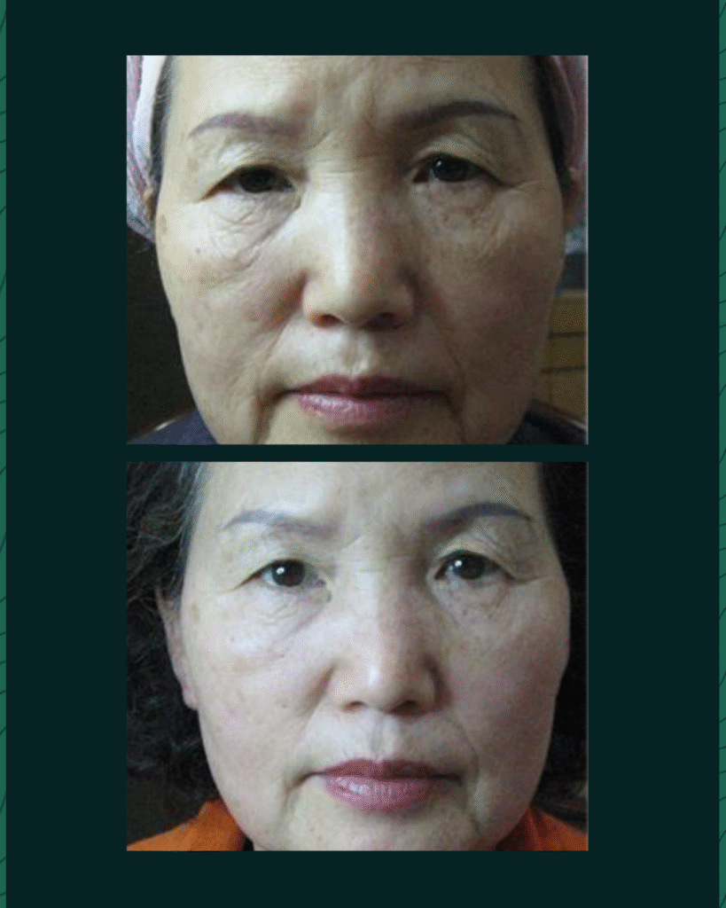 HIFU Device - Before After