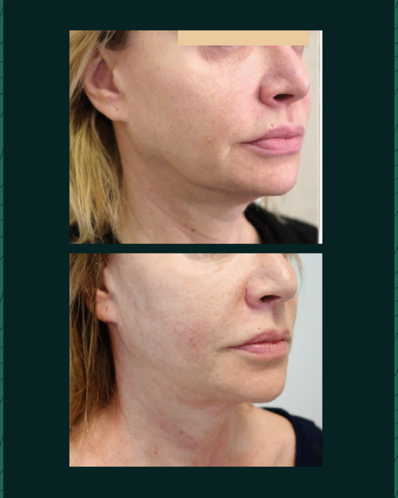 HIFU Device - Before After