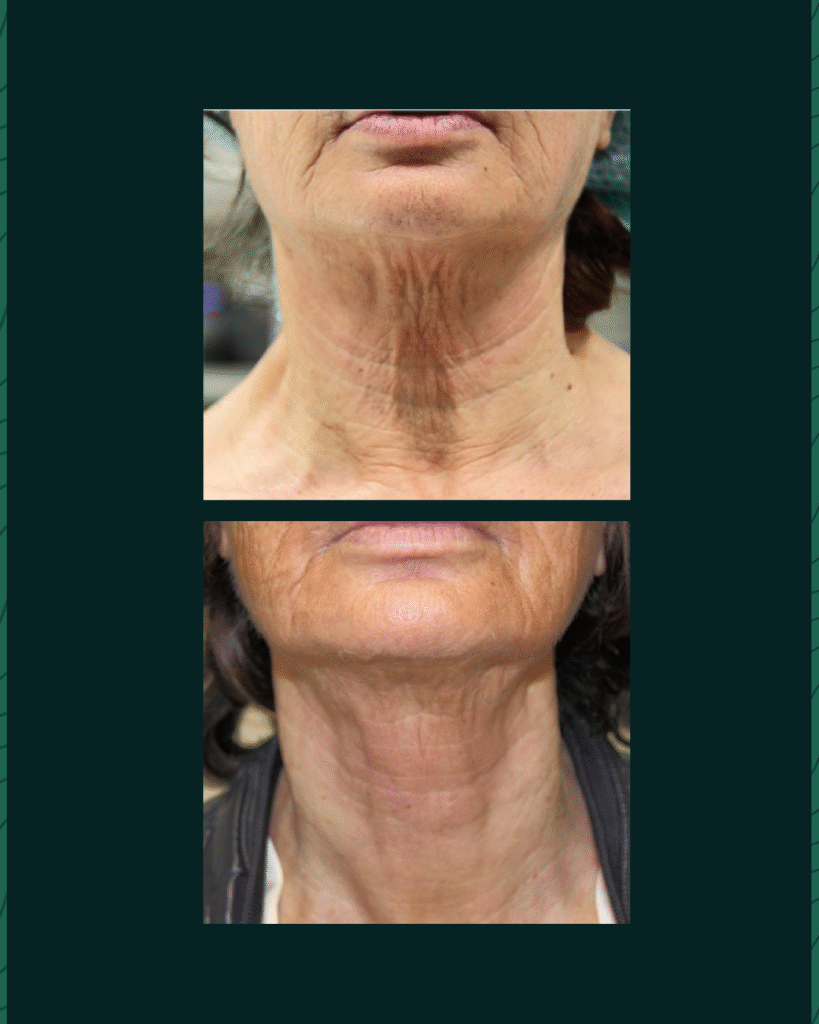 HIFU Device - Before After