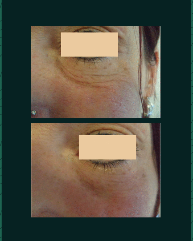 HIFU Device - Before After